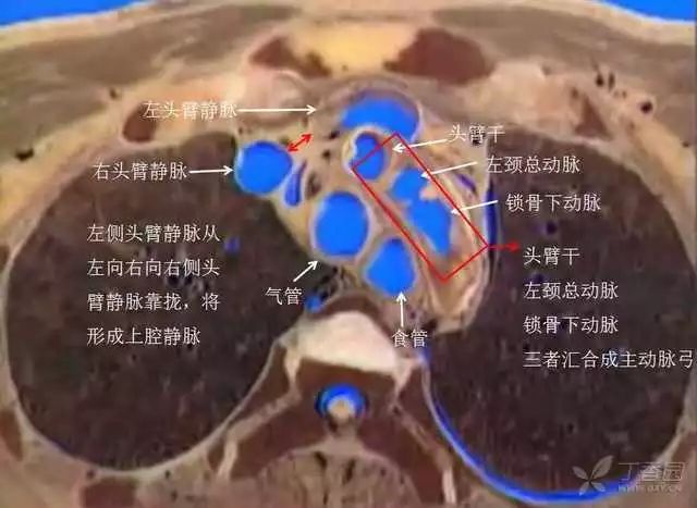 匯合成頭臂靜脈,也看不到右側頸總動脈和右側鎖骨下動脈匯合成頭臂幹