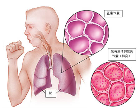 梅奥诊所帮您了解肺炎的症状和原因