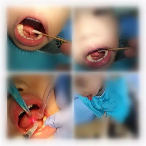 小孩舌系带短手术图片图片