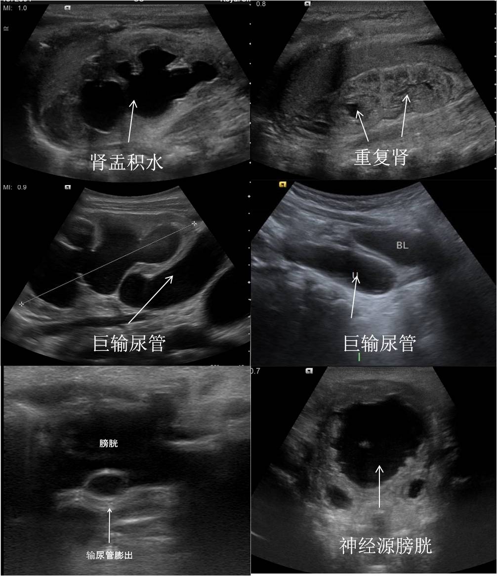 膀胱三角区超声图图片