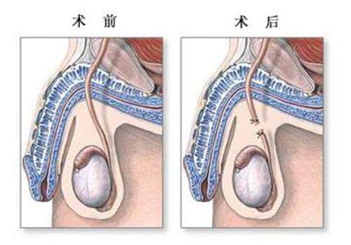 男性结扎手术是截断什么?对男性有多大危害?