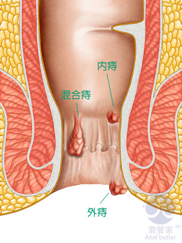 内痔长在哪里图解图片