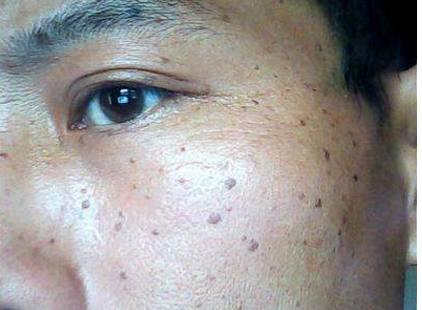 肝病患者脸上肝斑图片图片