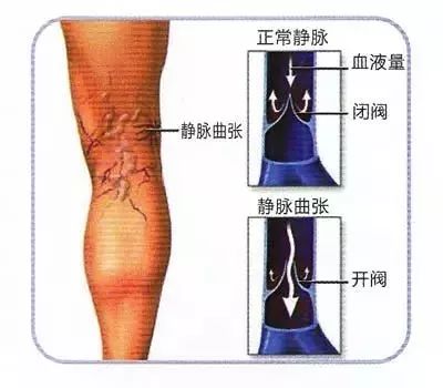 腿部静脉窦图片