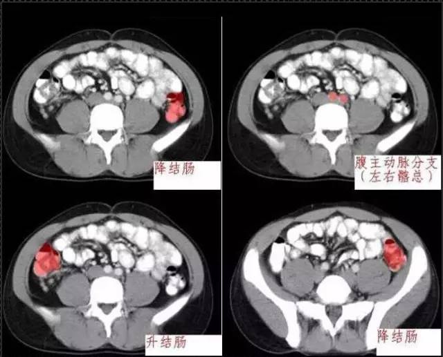 十分钟学会腹部 ct 解剖