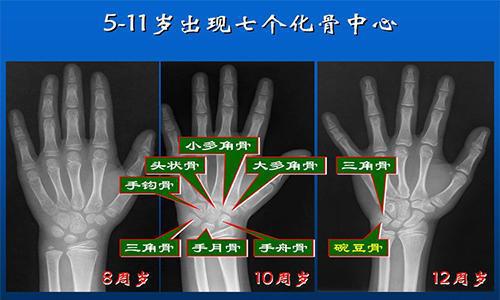 很久没长高,是不是骨骺线闭合了怎么判断自己的骨骺线状态?