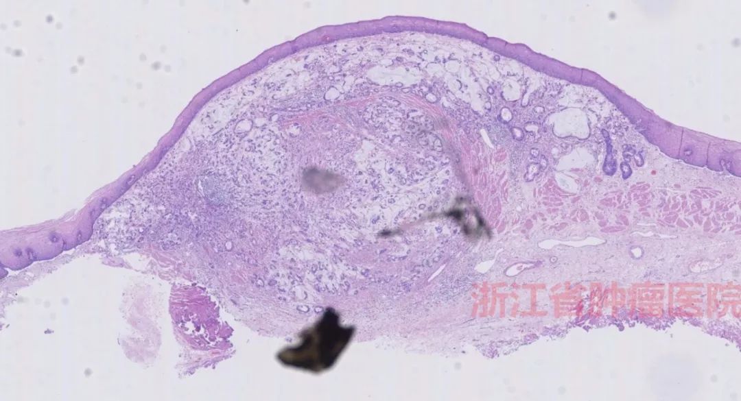 病变表面鳞状上皮结构基本正常,未见明显的异型增生,但是粘膜固有层