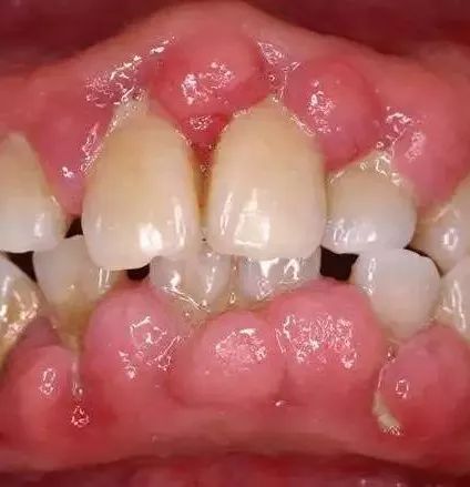 牙周病治疗方法了解一下炎症初期别耽误