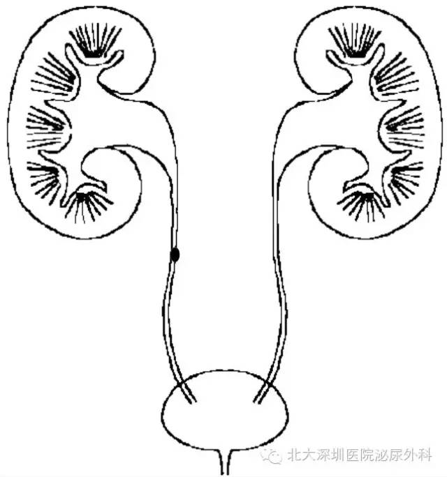 腎結石>20mm,多發,鑄型結石等,或者輸尿管上段靠近腎盂的結石;適用