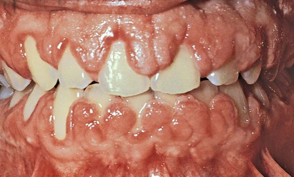 牙龈增生是怎么回事图片