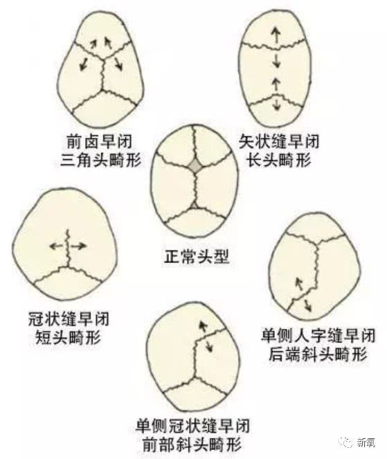 额骨骨缝图片