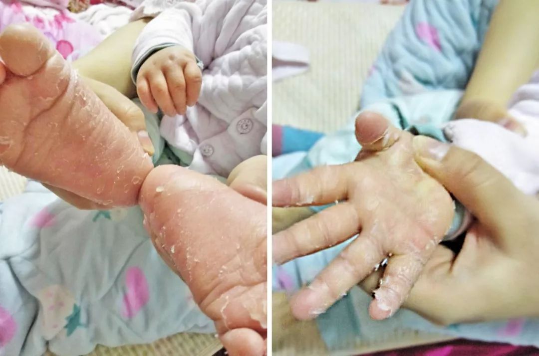 专家在线丨宝宝手脚脱皮就是缺乏维生素了吗?原因并非那么简单