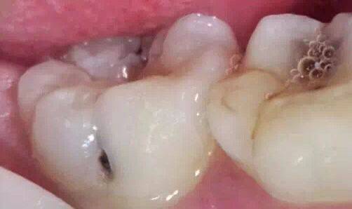 这时病变已经破坏到牙本质浅层了,牙齿已经有龋洞形成,对酸甜食物