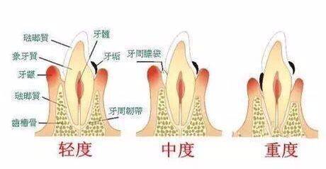 從牙齒有小黑點到拔牙,為什麼牙齒就這樣離開了您!