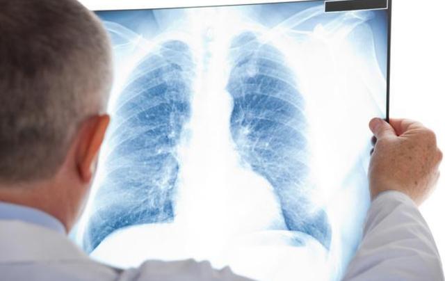 肺癌早期八个信号前期图片