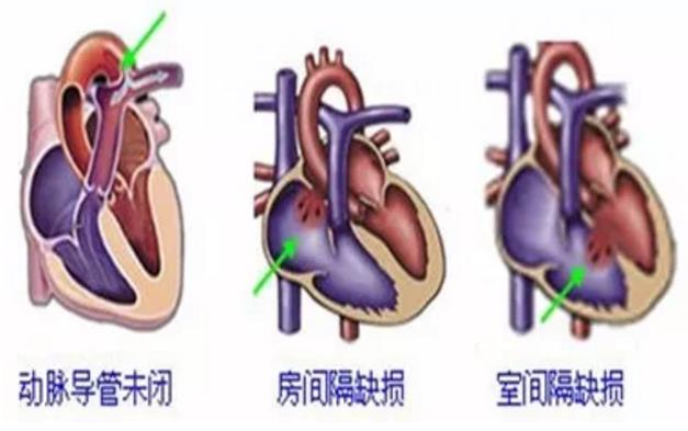 江南医生育儿芝士堡--卵圆孔未闭是先天性心脏病么?