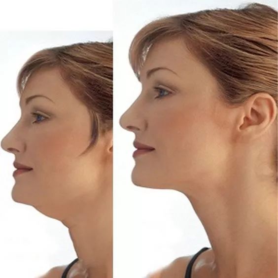 低头族不仅对颈椎不好,也让脖子前倾形成双下巴,双下巴脂肪堆积就容易