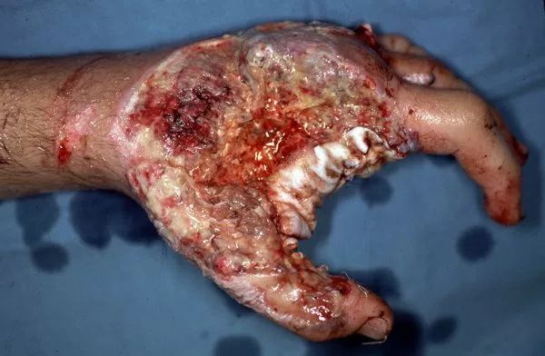 坏死性筋膜炎的症状图图片