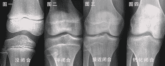 关于孩子骨骺线这5个事实妈妈们必须要了解