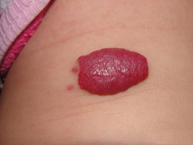 豆粒大的血管瘤图片图片