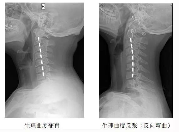 盤前厚後薄形成的,這也是人體生理結構的需要,同時不會讓頸椎間盤突出