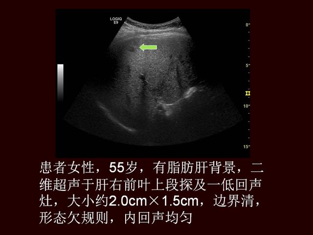 超聲造影提高原發性肝癌的診斷靈敏度