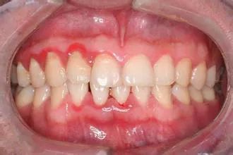 早期牙周炎:除牙龈炎症外,牙周袋形成,牙槽骨轻度吸收