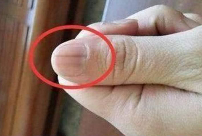 指甲竖纹多是癌症图片图片