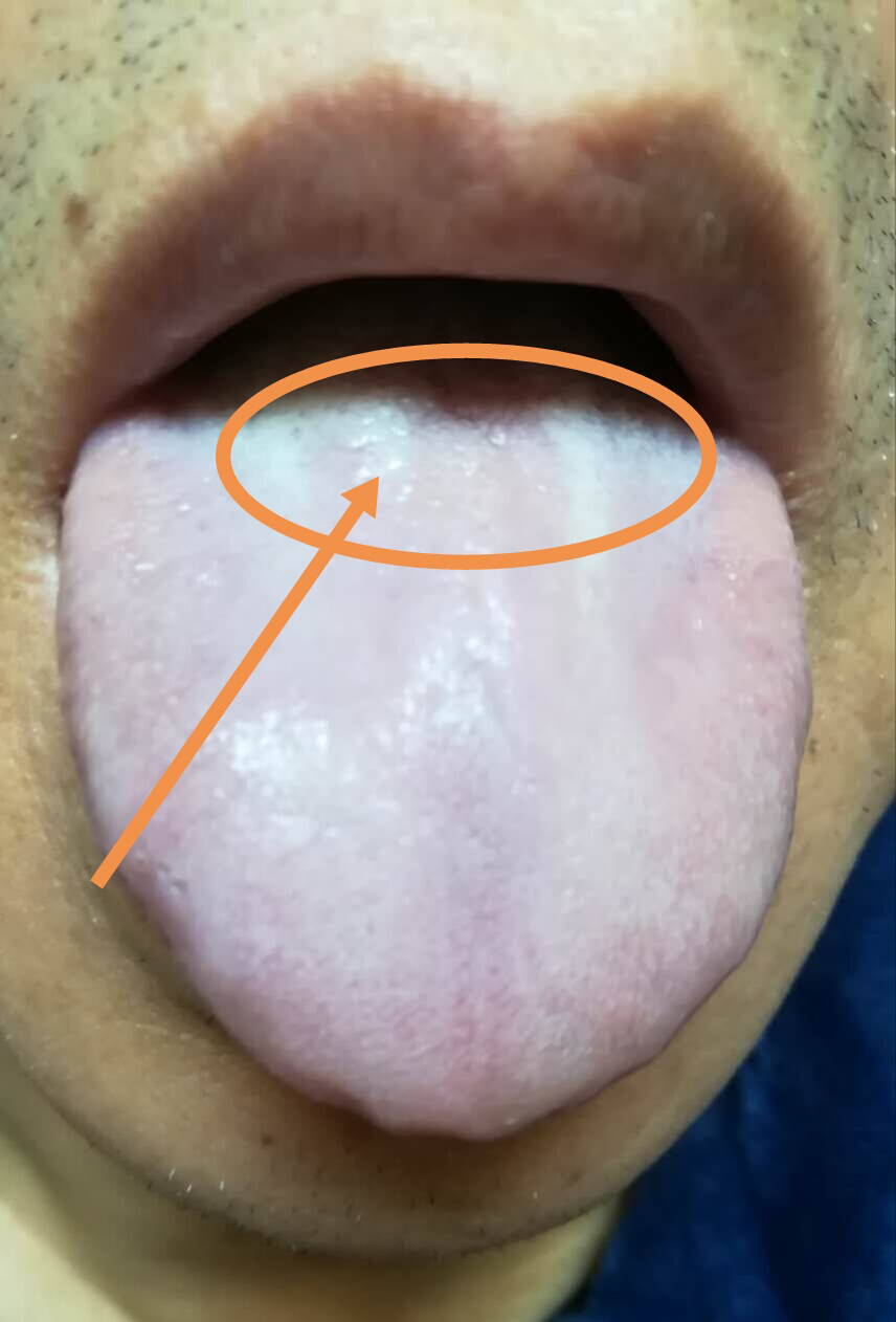 肾不好的舌头图图片