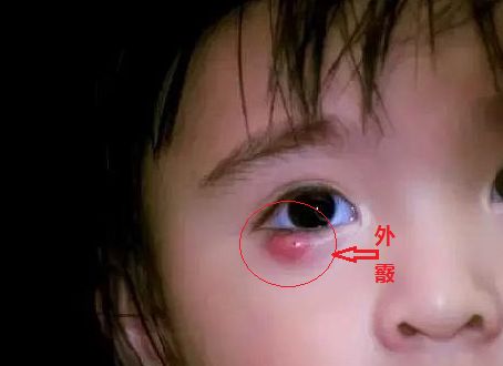 儿童眼睛肉芽肿图片图片