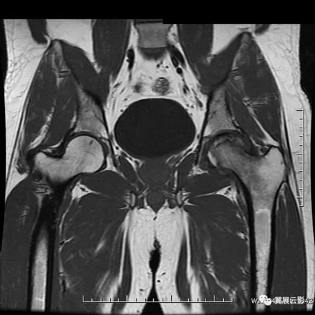 股骨头坏死双线征图片图片
