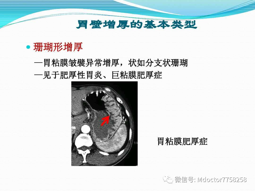 胃壁增厚疾病ctmri影像表现