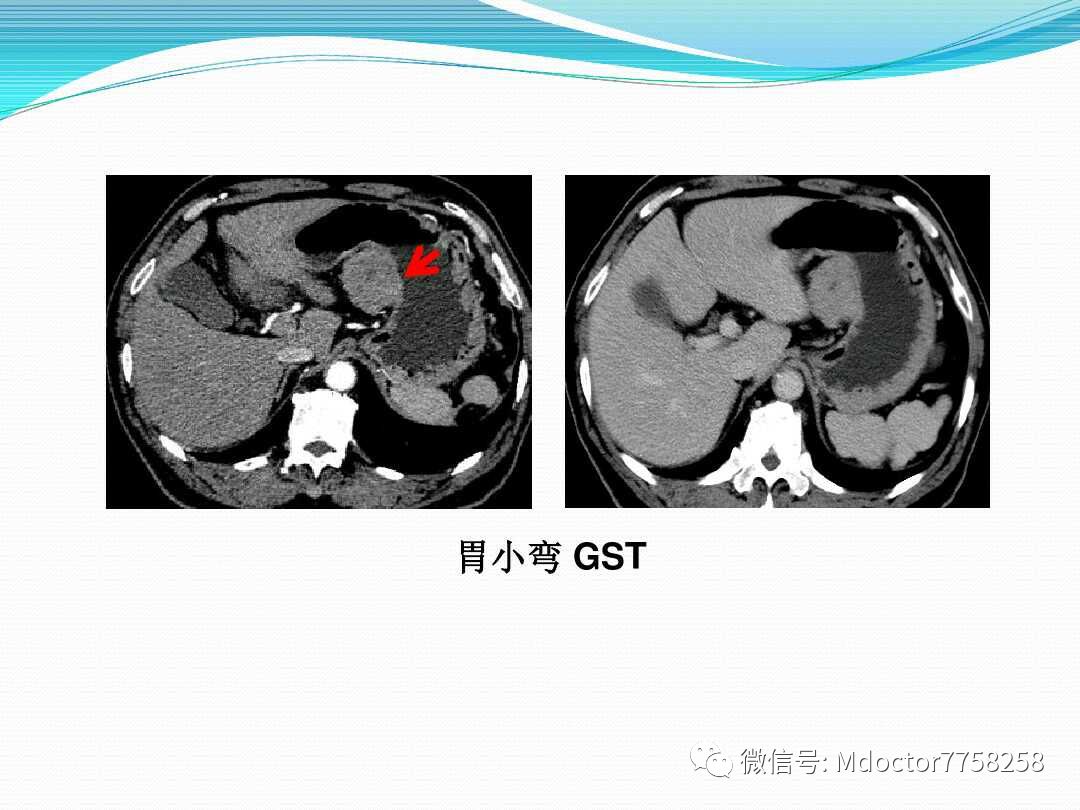 胃壁增厚疾病ctmri影像表现