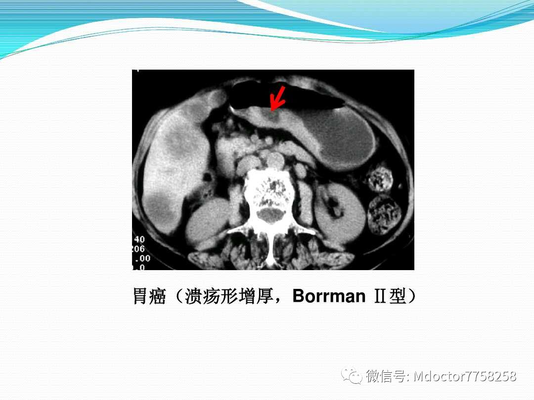 胃壁增厚疾病ctmri影像表现
