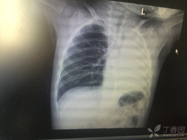 读片:左侧白肺,考虑什么?