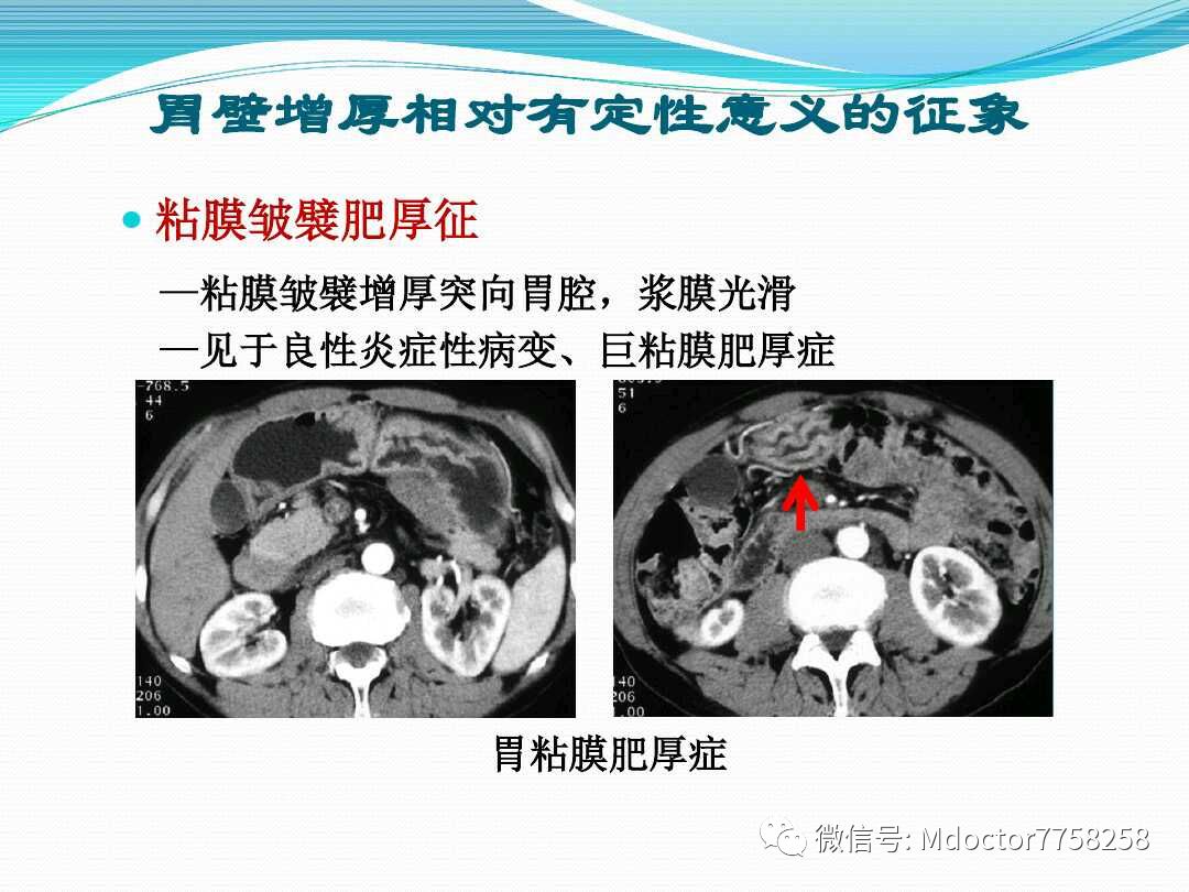 胃壁厚度图片