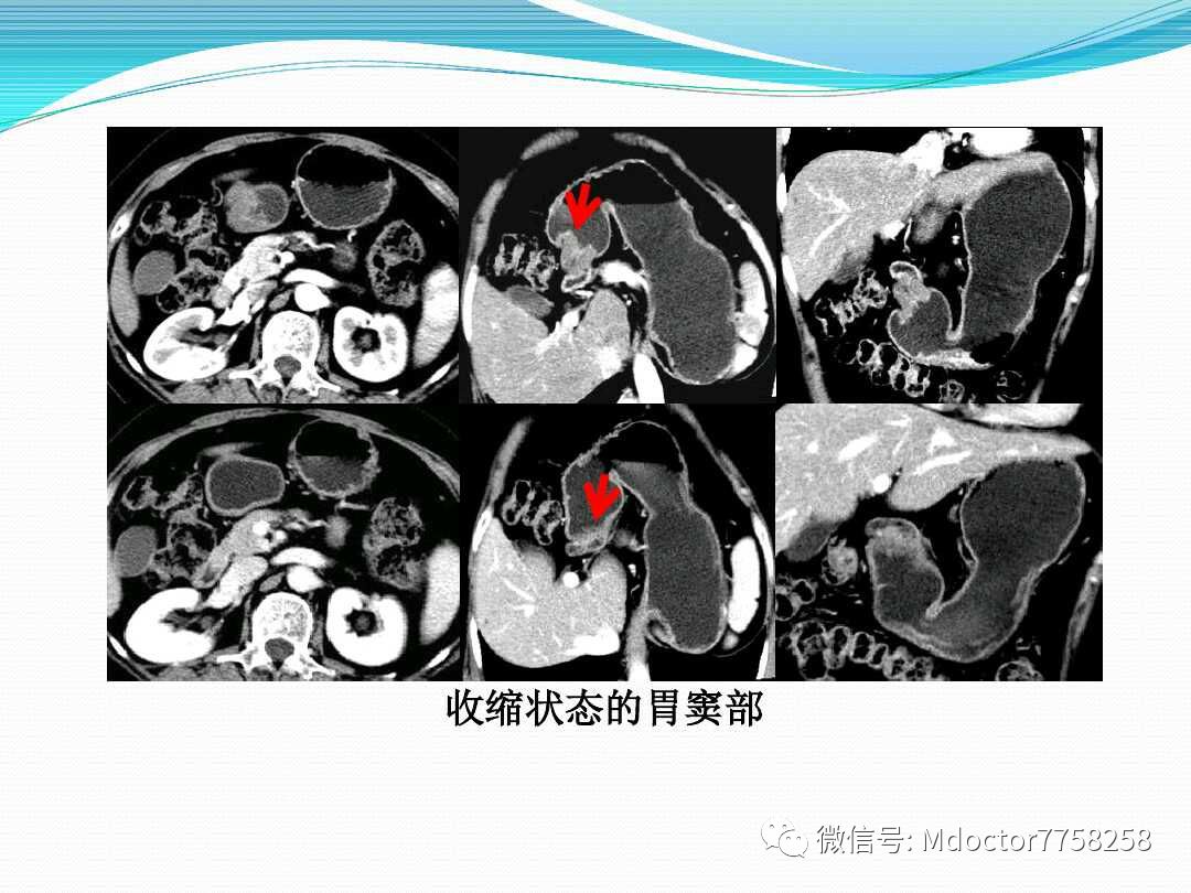 胃壁增厚疾病ctmri影像表现