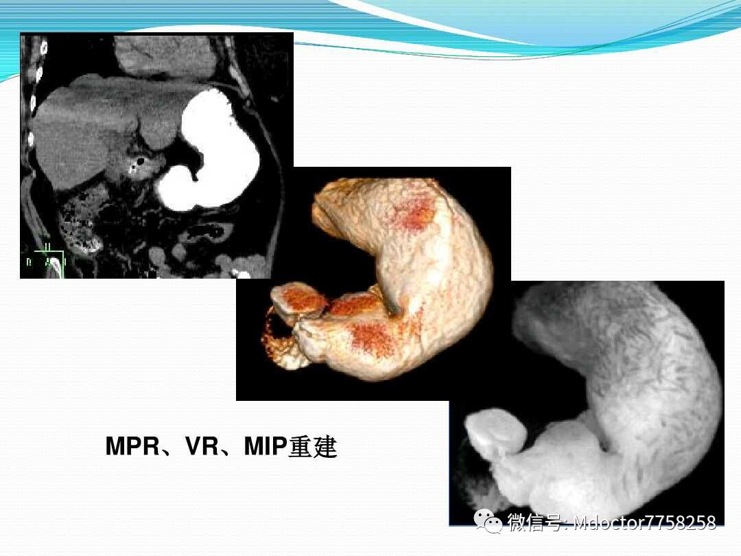 胃壁增厚疾病ctmri影像表现