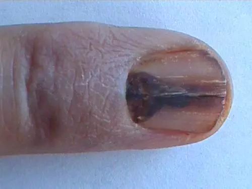 指甲花染头发癌症图片