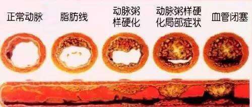 要想徹底治療冠心病腦血栓必須從護肝入手