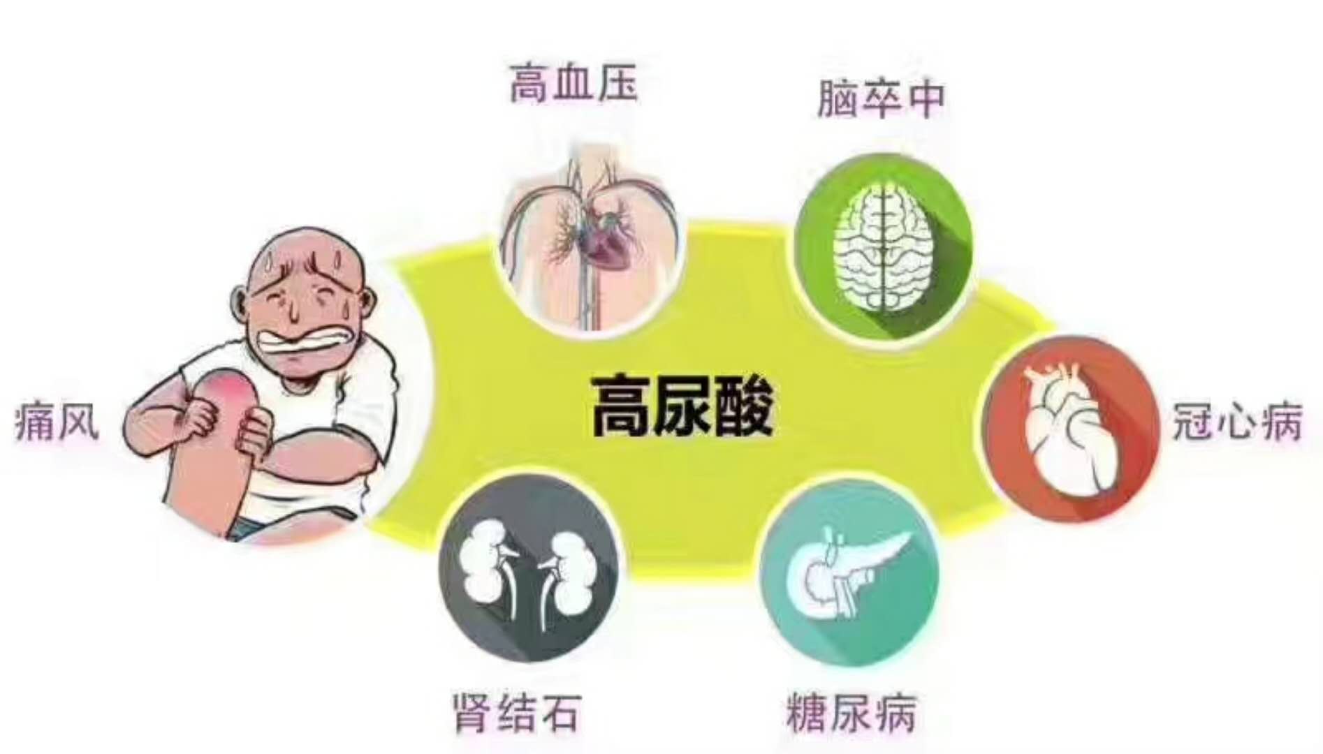 痛風把握降尿酸藥物的應用時機很重要