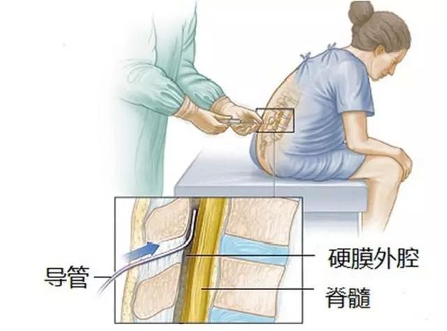 产妇痛得死去活来丈夫拒绝无痛分娩签字打麻醉对孩子有影响