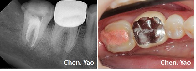病例十四下颌第二磨牙根管再治疗一例