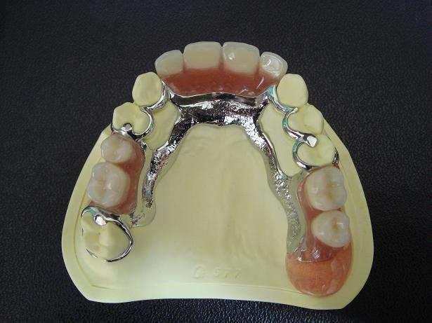 缺牙后不镶牙对其他牙齿造成的影响你们知道吗?