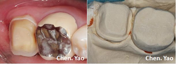 病例十四下颌第二磨牙根管再治疗一例
