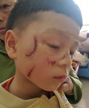 心疼!苹果专卖店一玻璃门突然爆裂…4岁孩童脸蛋被割伤