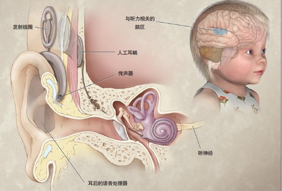 人工耳蜗和助听器区别图片