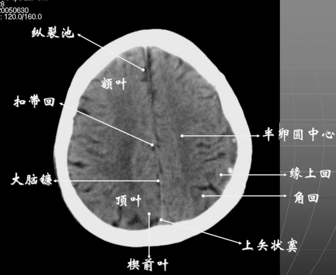 头颅ct扫描定位线图片图片