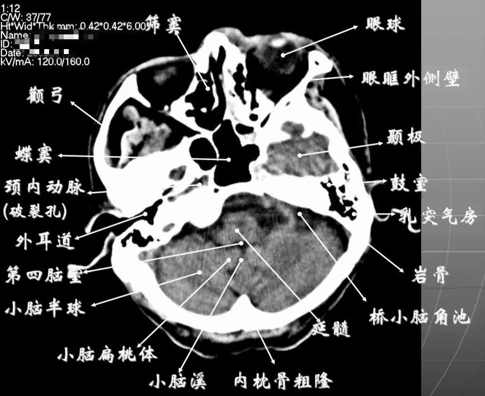 头部cta完整解剖图解图片