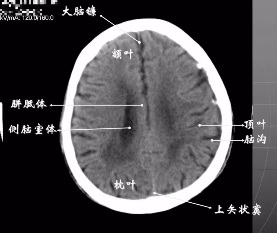 侧脑室三角区CT解剖图图片